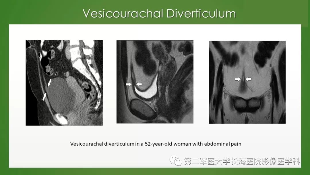 【PPT】脐尿管异常的影像表现与临床