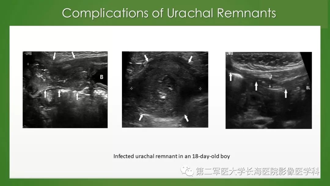 【PPT】脐尿管异常的影像表现与临床