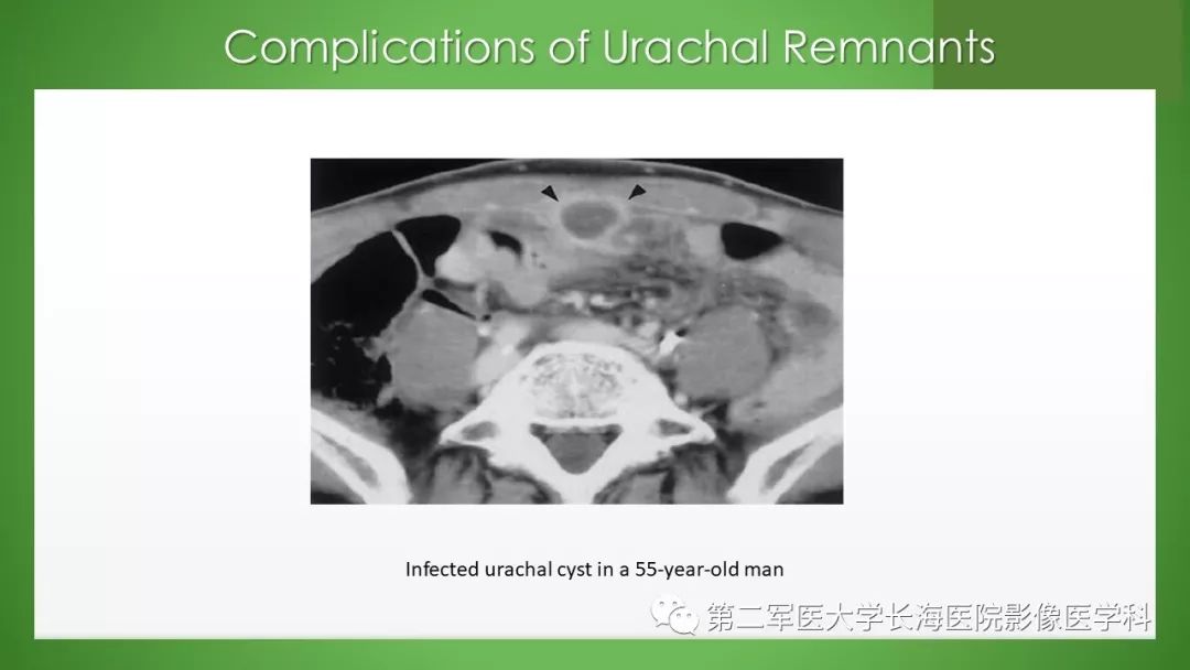 【PPT】脐尿管异常的影像表现与临床