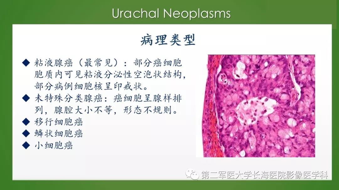 【PPT】脐尿管异常的影像表现与临床