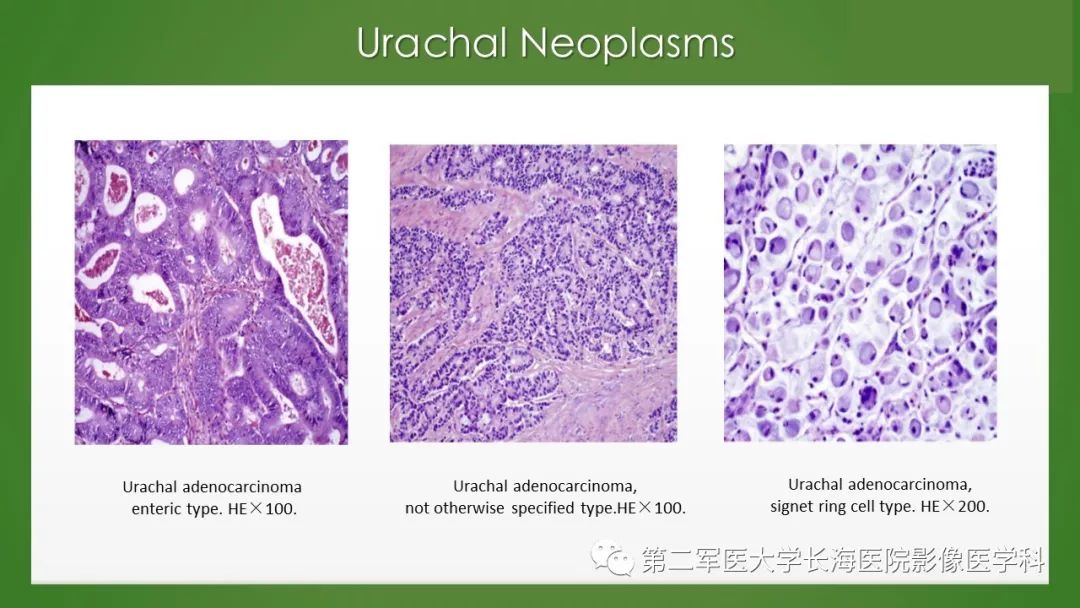 【PPT】脐尿管异常的影像表现与临床