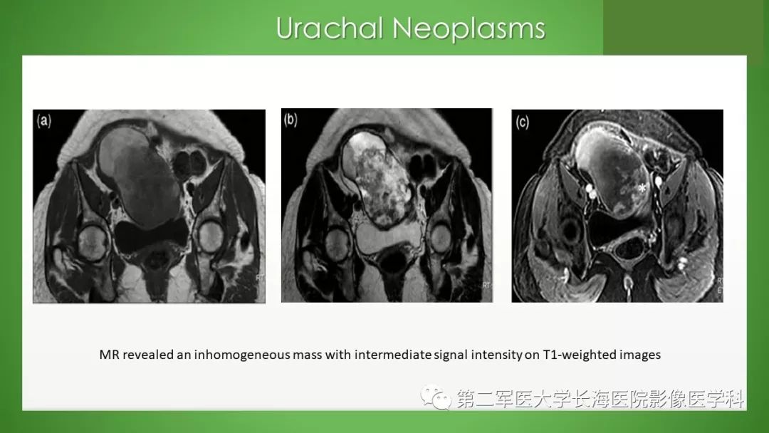 【PPT】脐尿管异常的影像表现与临床
