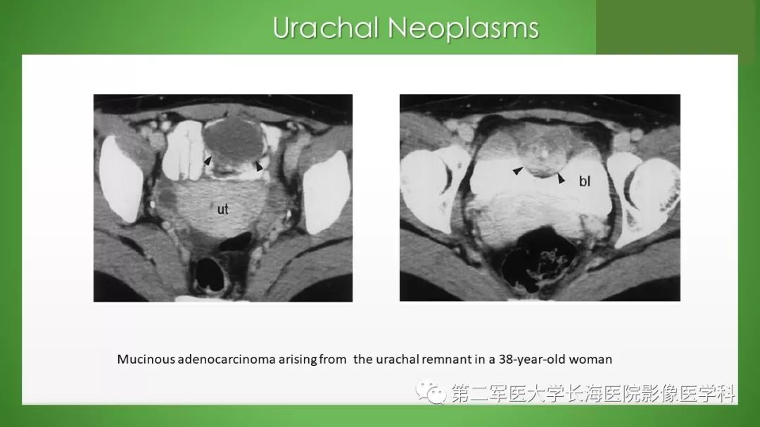 【PPT】脐尿管异常的影像表现与临床