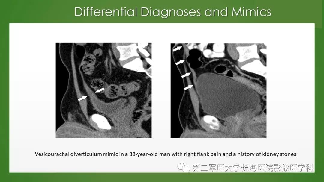 【PPT】脐尿管异常的影像表现与临床