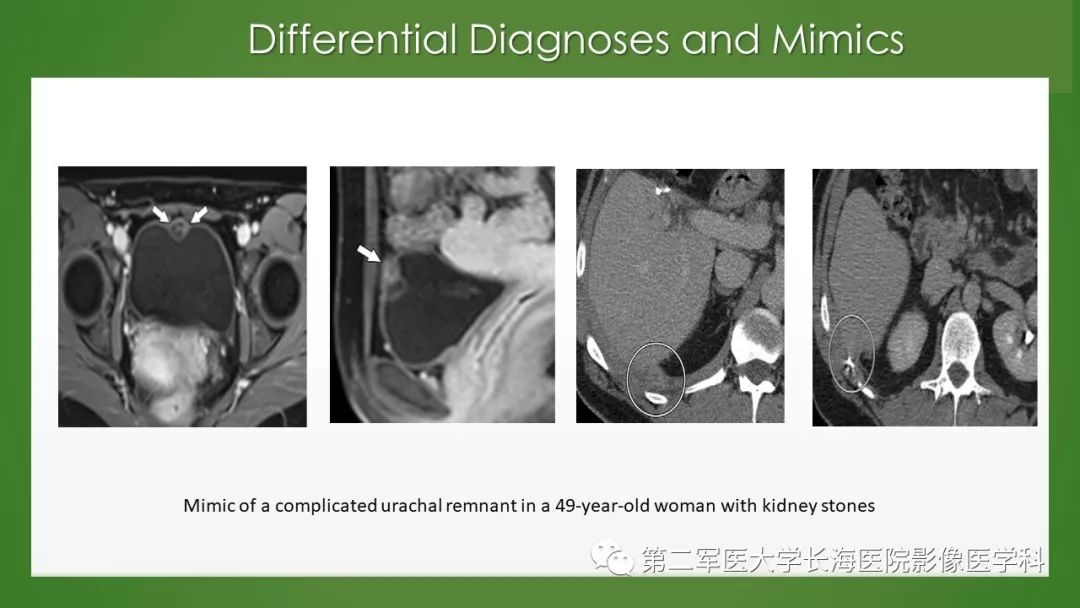 【PPT】脐尿管异常的影像表现与临床
