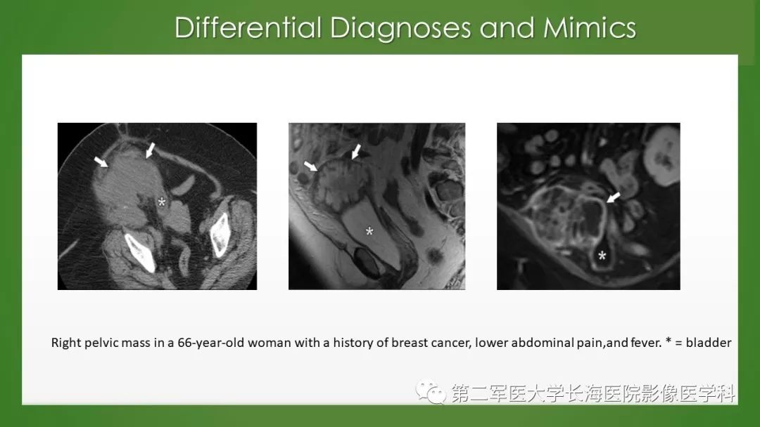 【PPT】脐尿管异常的影像表现与临床