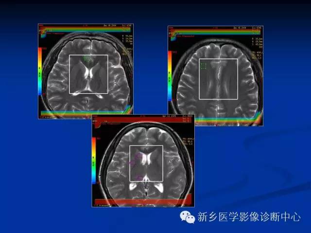 【PPT】青年抑郁症患者脑的3D H MRS和DTI研究