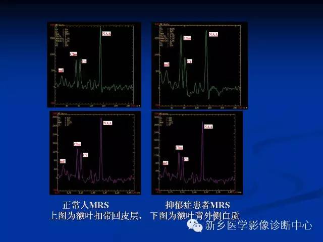 【PPT】青年抑郁症患者脑的3D H MRS和DTI研究