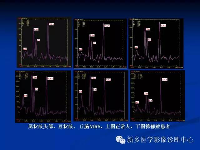 【PPT】青年抑郁症患者脑的3D H MRS和DTI研究