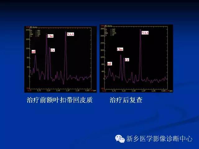 【PPT】青年抑郁症患者脑的3D H MRS和DTI研究