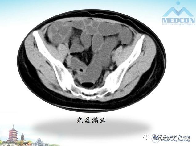 【PPT】小肠肿瘤影像学表现与病理相关分析