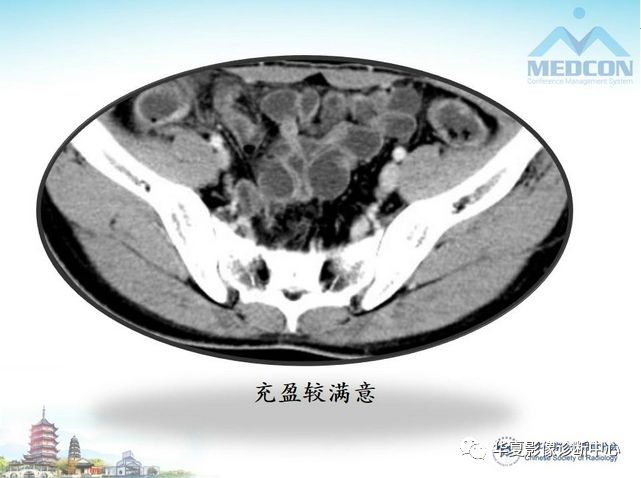 【PPT】小肠肿瘤影像学表现与病理相关分析
