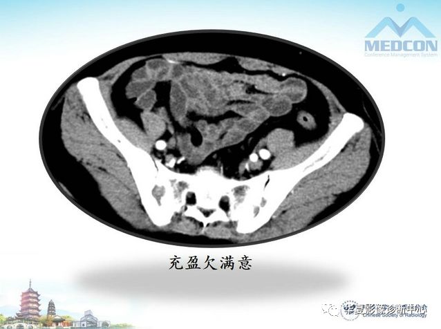 【PPT】小肠肿瘤影像学表现与病理相关分析