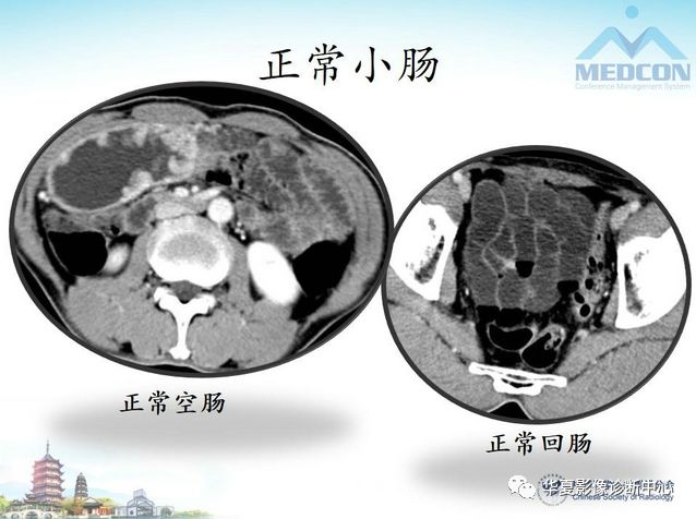 【PPT】小肠肿瘤影像学表现与病理相关分析