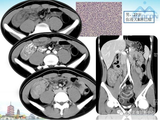 【PPT】小肠肿瘤影像学表现与病理相关分析
