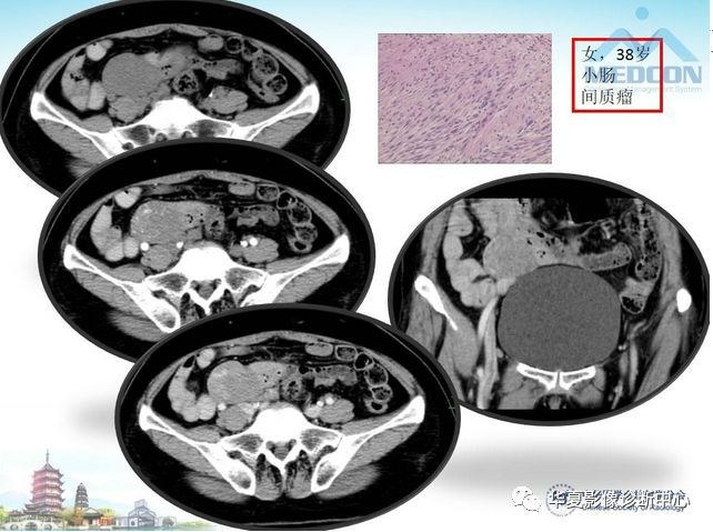 【PPT】小肠肿瘤影像学表现与病理相关分析