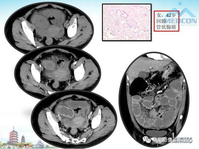 【PPT】小肠肿瘤影像学表现与病理相关分析