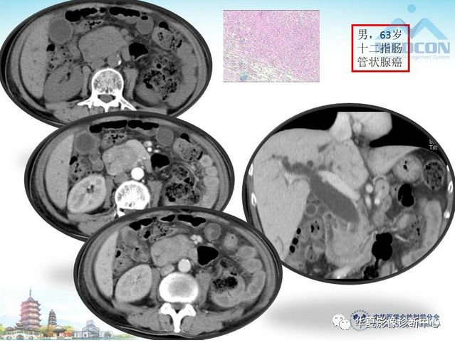 【PPT】小肠肿瘤影像学表现与病理相关分析