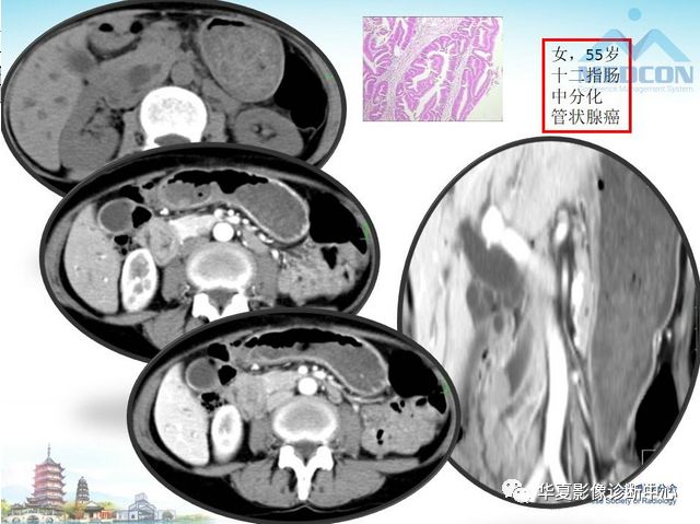 【PPT】小肠肿瘤影像学表现与病理相关分析