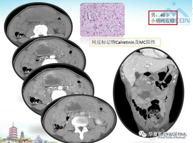【PPT】小肠肿瘤影像学表现与病理相关分析