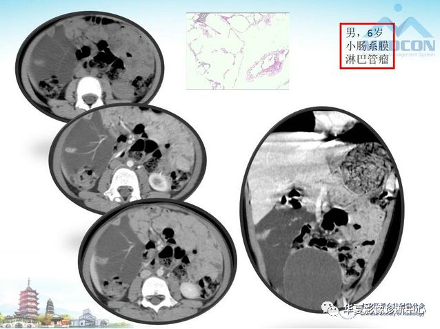 【PPT】小肠肿瘤影像学表现与病理相关分析