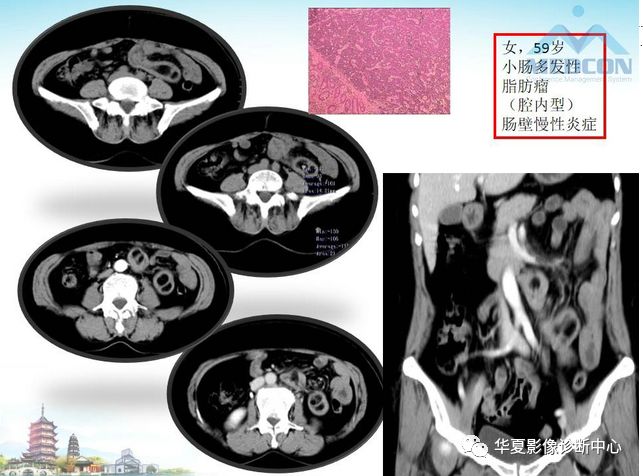 【PPT】小肠肿瘤影像学表现与病理相关分析
