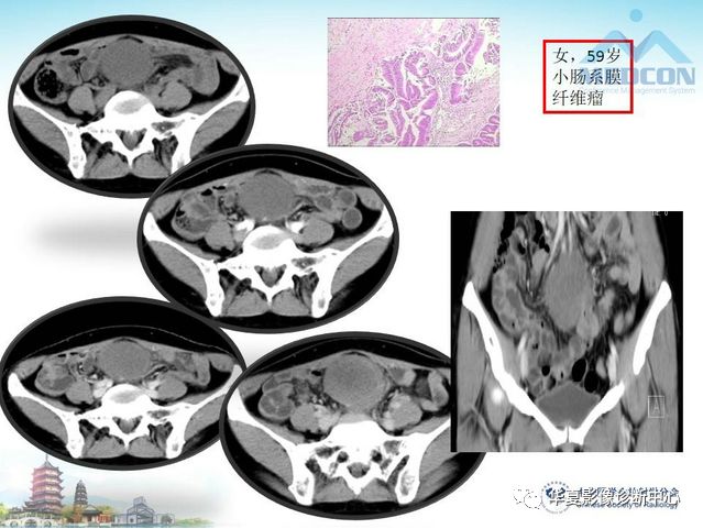 【PPT】小肠肿瘤影像学表现与病理相关分析