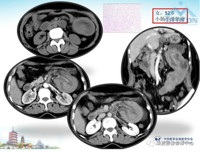 【PPT】小肠肿瘤影像学表现与病理相关分析