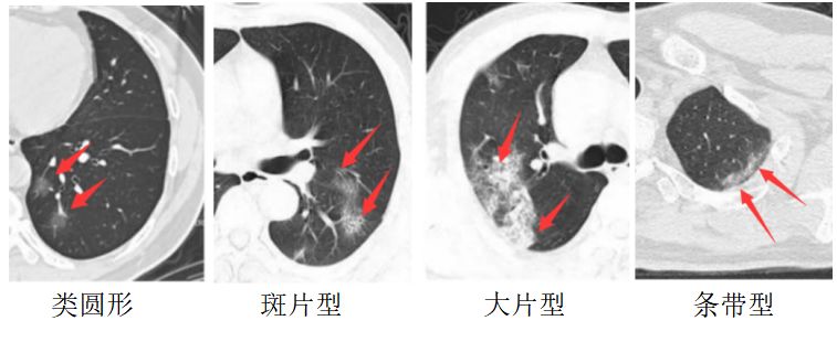 新型冠状病毒肺炎影像征象分析 新型冠状病毒肺炎影像征象分析