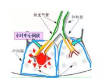 新型冠状病毒肺炎影像征象分析 新型冠状病毒肺炎影像征象分析