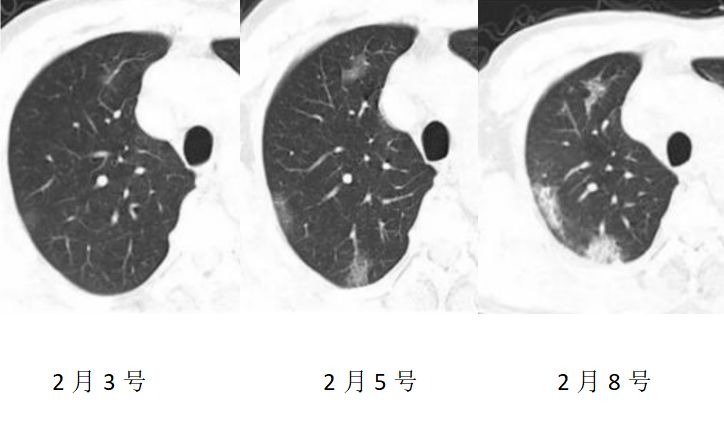 新型冠状病毒肺炎影像征象分析 新型冠状病毒肺炎影像征象分析