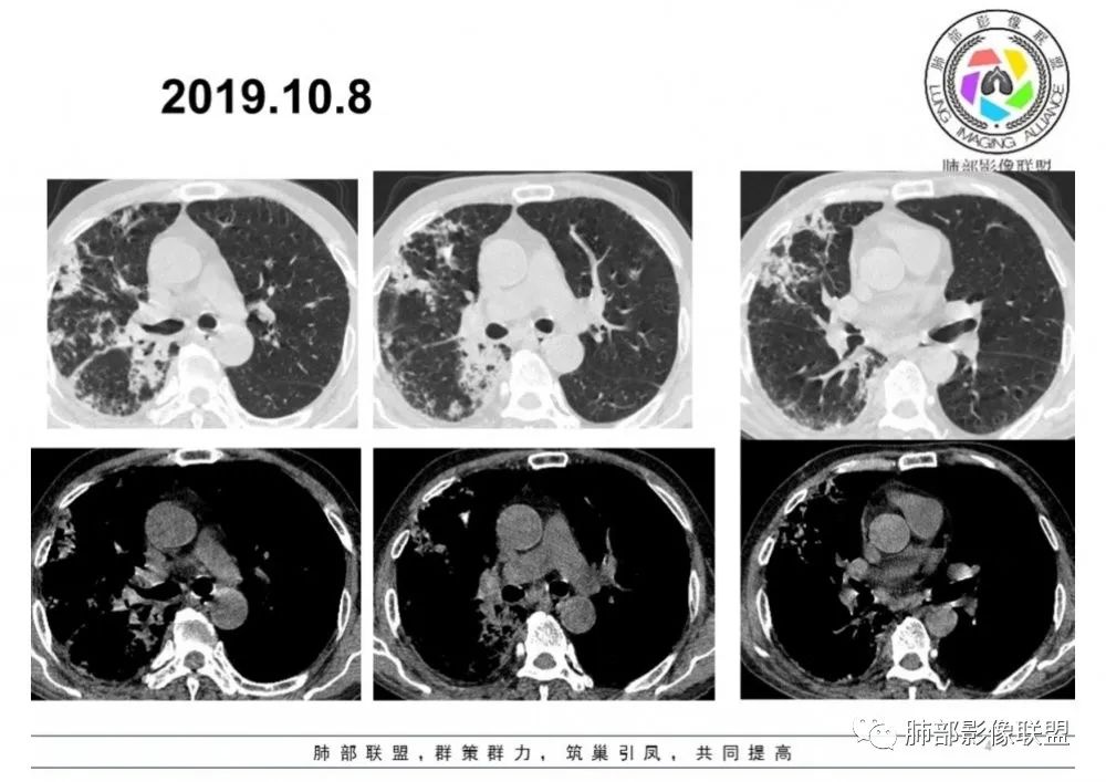【病例】结核千面妖