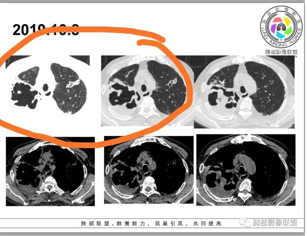 【病例】结核千面妖 【病例】结核千面妖