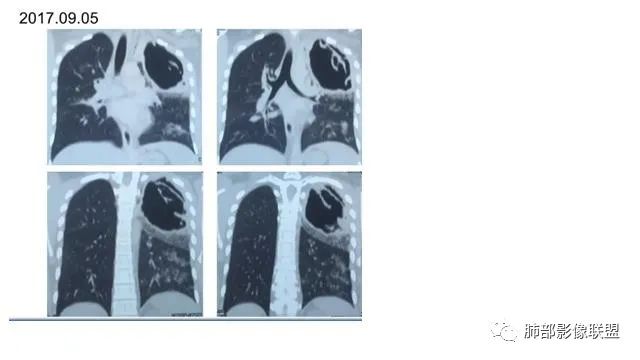 【病例】结核千面妖 【病例】结核千面妖