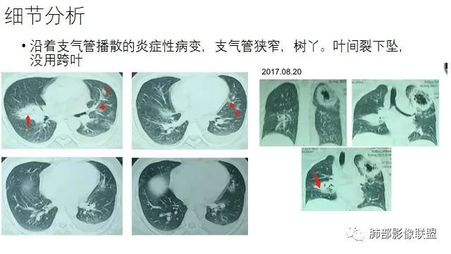 【病例】结核千面妖 【病例】结核千面妖