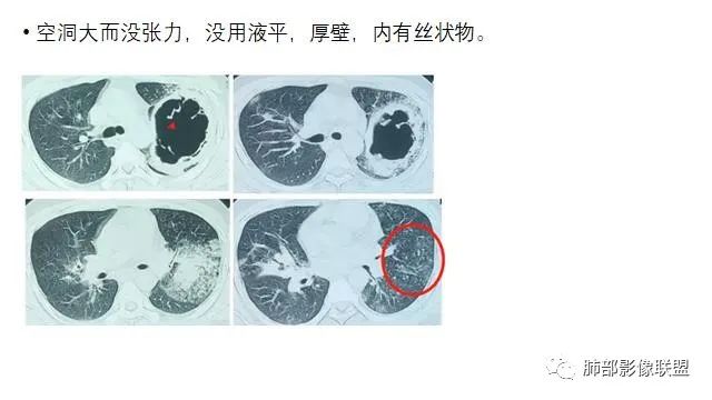 【病例】结核千面妖 【病例】结核千面妖