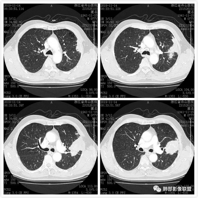 【病例】真假支气管爬行征—肺腺癌1例CT影像讨论 【病例】真假支气管爬行征—肺腺癌1例CT影像讨论