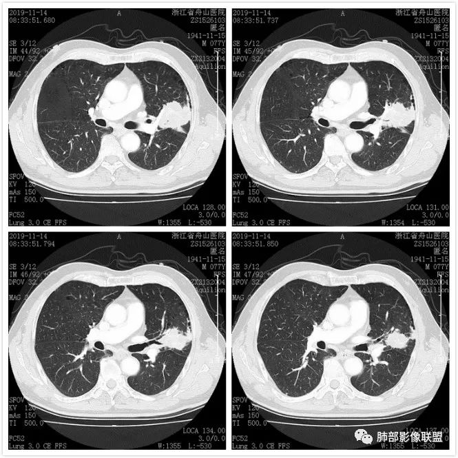 【病例】真假支气管爬行征—肺腺癌1例CT影像讨论 【病例】真假支气管爬行征—肺腺癌1例CT影像讨论