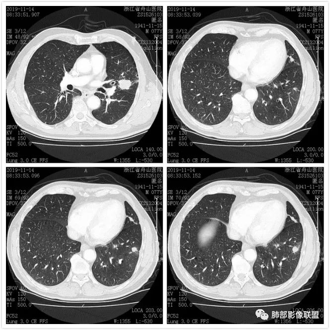 【病例】真假支气管爬行征—肺腺癌1例CT影像讨论 【病例】真假支气管爬行征—肺腺癌1例CT影像讨论