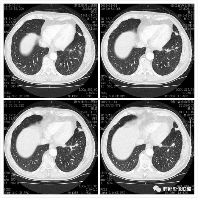 【病例】真假支气管爬行征—肺腺癌1例CT影像讨论 【病例】真假支气管爬行征—肺腺癌1例CT影像讨论