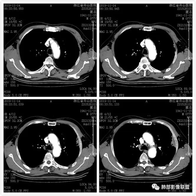 【病例】真假支气管爬行征—肺腺癌1例CT影像讨论 【病例】真假支气管爬行征—肺腺癌1例CT影像讨论