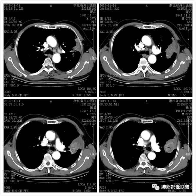 【病例】真假支气管爬行征—肺腺癌1例CT影像讨论 【病例】真假支气管爬行征—肺腺癌1例CT影像讨论