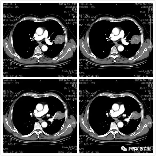 【病例】真假支气管爬行征—肺腺癌1例CT影像讨论 【病例】真假支气管爬行征—肺腺癌1例CT影像讨论