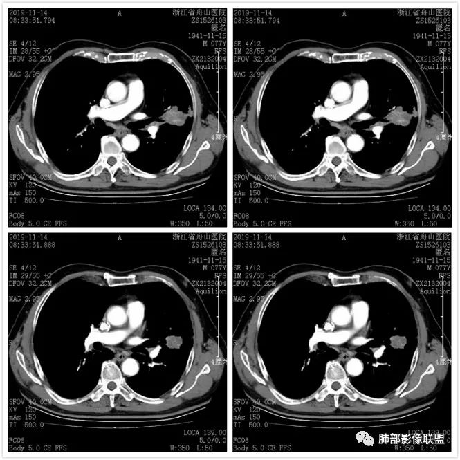【病例】真假支气管爬行征—肺腺癌1例CT影像讨论 【病例】真假支气管爬行征—肺腺癌1例CT影像讨论