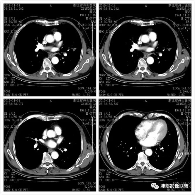 【病例】真假支气管爬行征—肺腺癌1例CT影像讨论 【病例】真假支气管爬行征—肺腺癌1例CT影像讨论