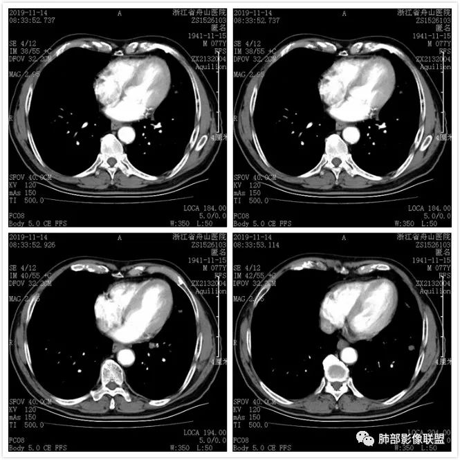 【病例】真假支气管爬行征—肺腺癌1例CT影像讨论 【病例】真假支气管爬行征—肺腺癌1例CT影像讨论