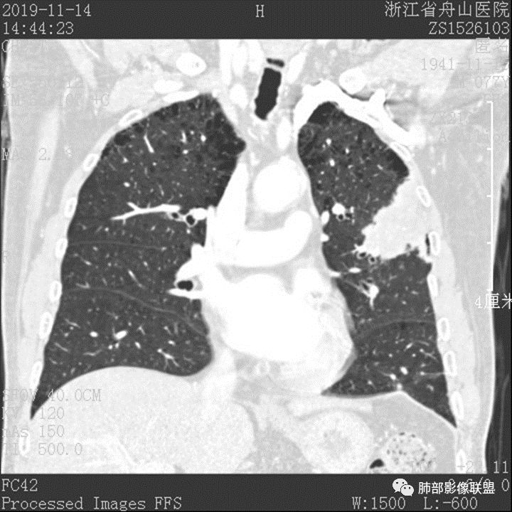 【病例】真假支气管爬行征—肺腺癌1例CT影像讨论 【病例】真假支气管爬行征—肺腺癌1例CT影像讨论