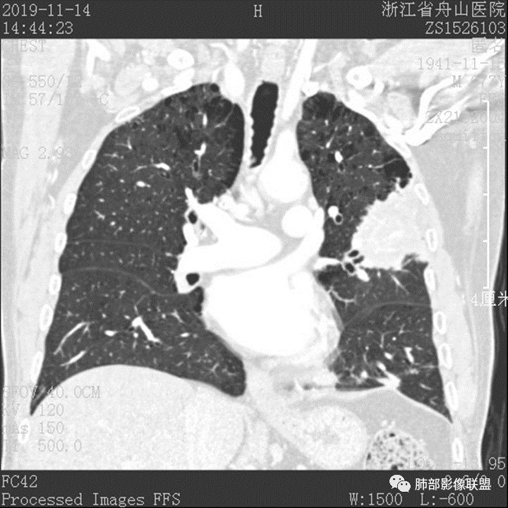【病例】真假支气管爬行征—肺腺癌1例CT影像讨论 【病例】真假支气管爬行征—肺腺癌1例CT影像讨论
