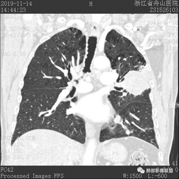 【病例】真假支气管爬行征—肺腺癌1例CT影像讨论 【病例】真假支气管爬行征—肺腺癌1例CT影像讨论