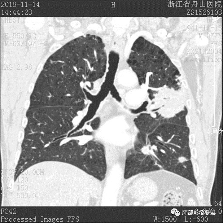 【病例】真假支气管爬行征—肺腺癌1例CT影像讨论 【病例】真假支气管爬行征—肺腺癌1例CT影像讨论